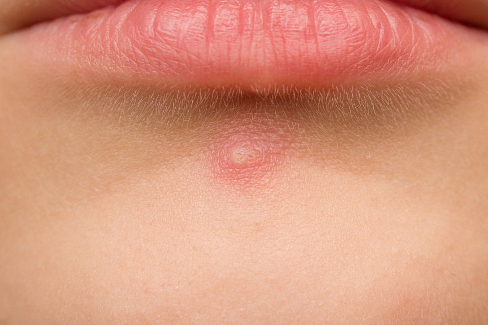 Pimples ka ayurvedic treatment