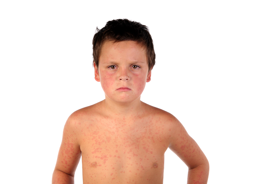 Measles Treatment